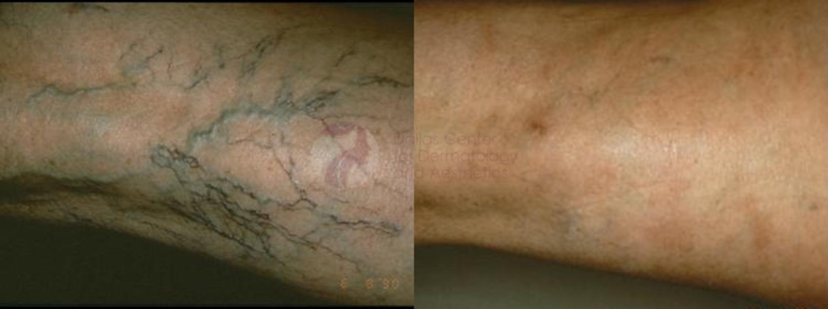 Before & After Sclerotherapy for Veins Case 35 Back View in Dallas, TX