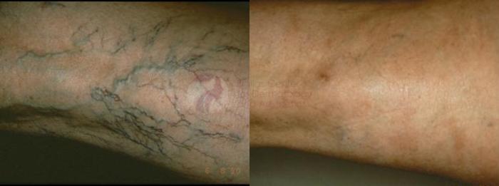 Before & After Sclerotherapy for Veins Case 35 Back View in Dallas, TX