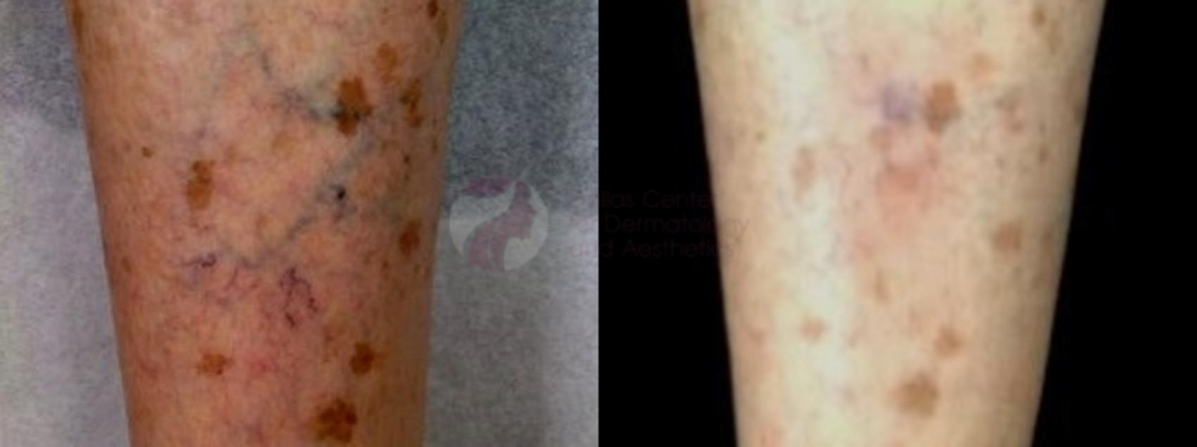 Sclerotherapy for Veins Before and After Photo Gallery | Dallas, Plano ...