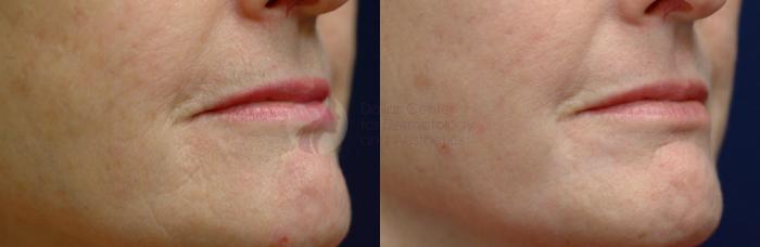 Before & After Skin Resurfacing Case 1 View #1 View in Dallas, TX