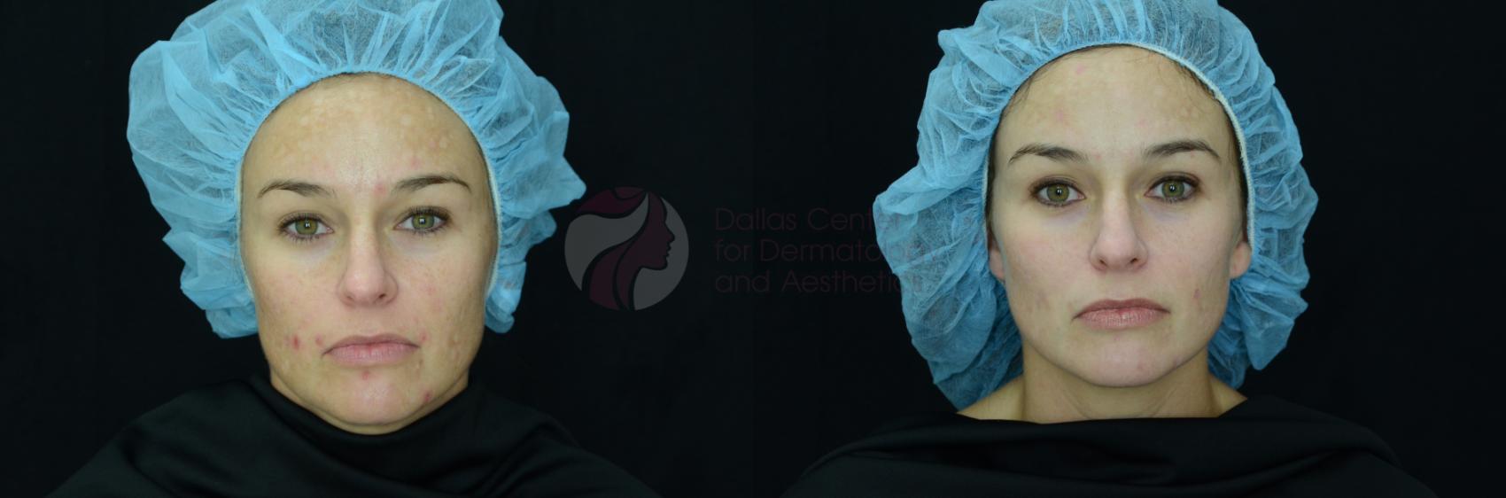 Before & After Skin Resurfacing Case 20 View #1 View in Dallas, Plano, and Frisco, TX