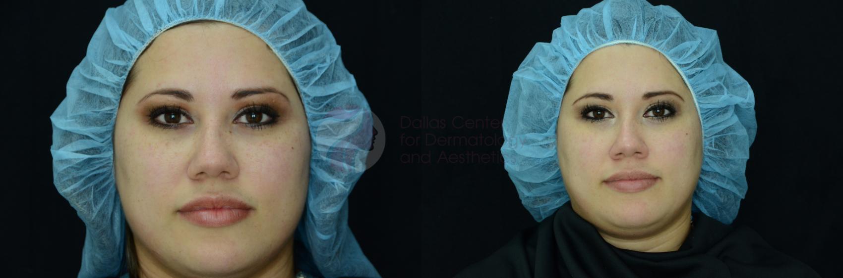 Before & After Skin Resurfacing Case 22 View #1 View in Dallas, Plano, and Frisco, TX