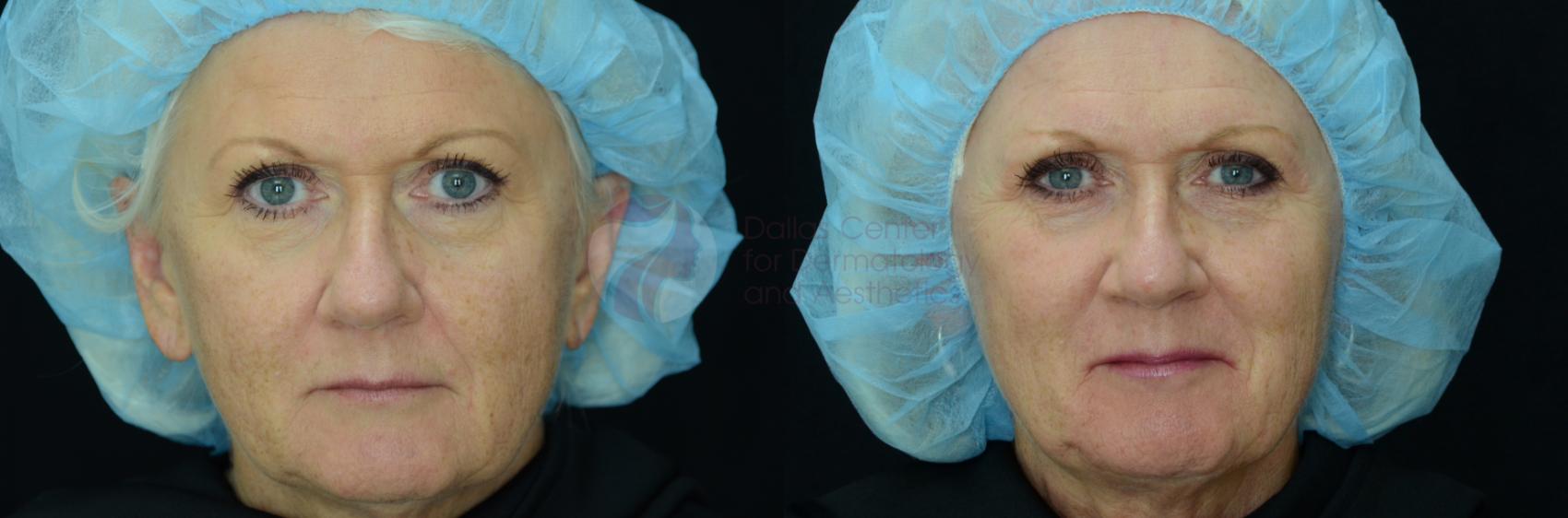 Before & After Skin Resurfacing Case 24 View #1 View in Dallas, Plano, and Frisco, TX