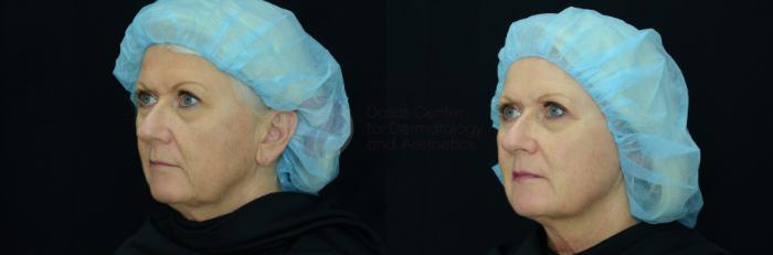 Before & After Skin Resurfacing Case 24 View #2 View in Dallas, TX