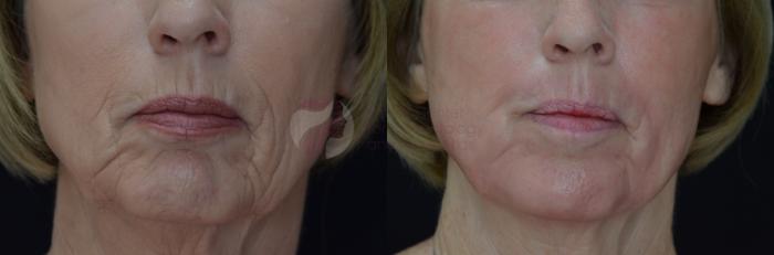 Before & After Skin Resurfacing Case 43 View #2 View in Dallas, TX