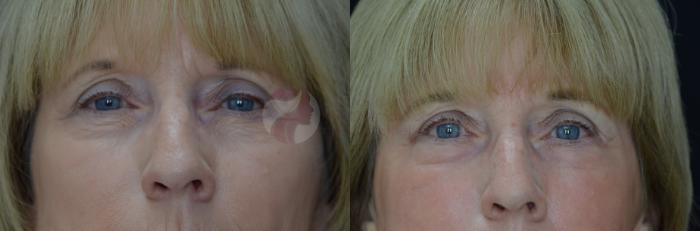 Before & After Skin Resurfacing Case 43 View #3 View in Dallas, TX
