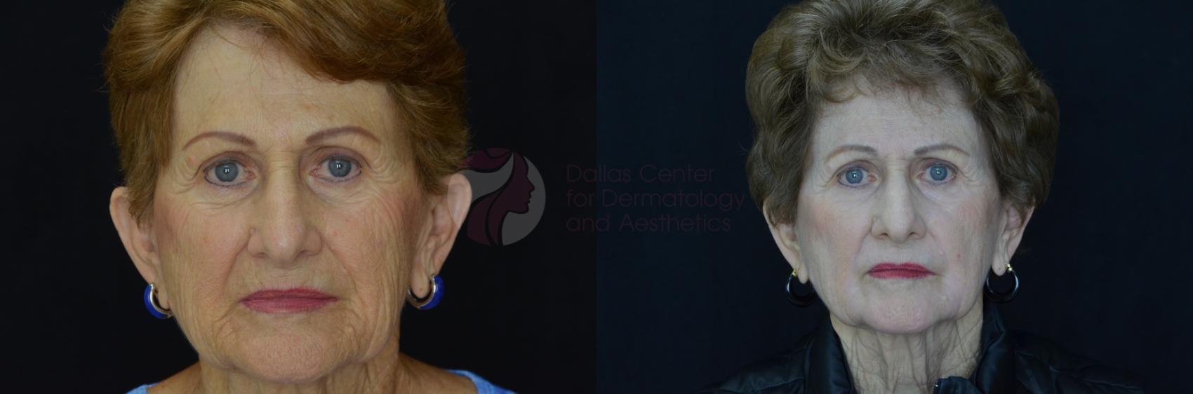 Before & After Skin Resurfacing Case 50 View #1 View in Dallas, Plano, and Frisco, TX