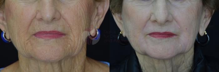 Before & After Skin Resurfacing Case 50 View #2 View in Dallas, TX