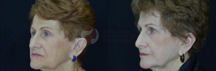 Before & After Skin Resurfacing Case 50 View #3 View in Dallas, TX