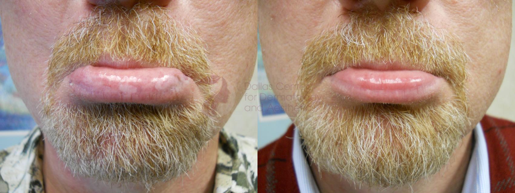 Before & After Skin Resurfacing Case 52 View #1 View in Dallas, TX