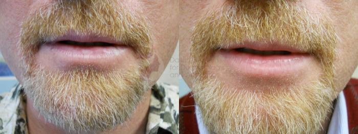 Before & After Skin Resurfacing Case 52 View #2 View in Dallas, TX