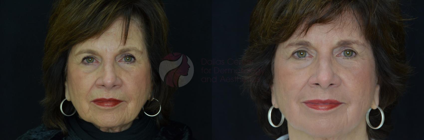 Before & After Skin Resurfacing Case 54 View #1 View in Dallas, TX