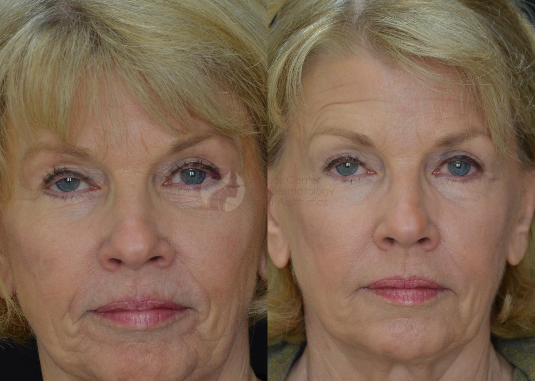 Before & After Skin Resurfacing Case 57 View #1 View in Plano, Frisco, Dallas, Texas