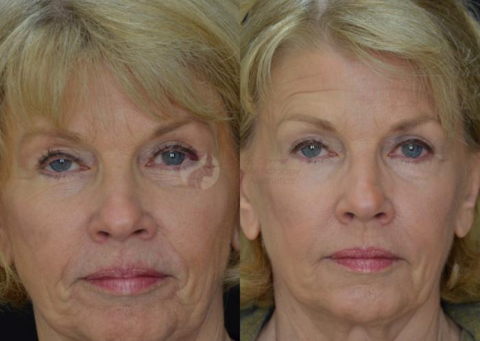 Before & After Skin Resurfacing Case 57 View #1 View in Dallas, TX