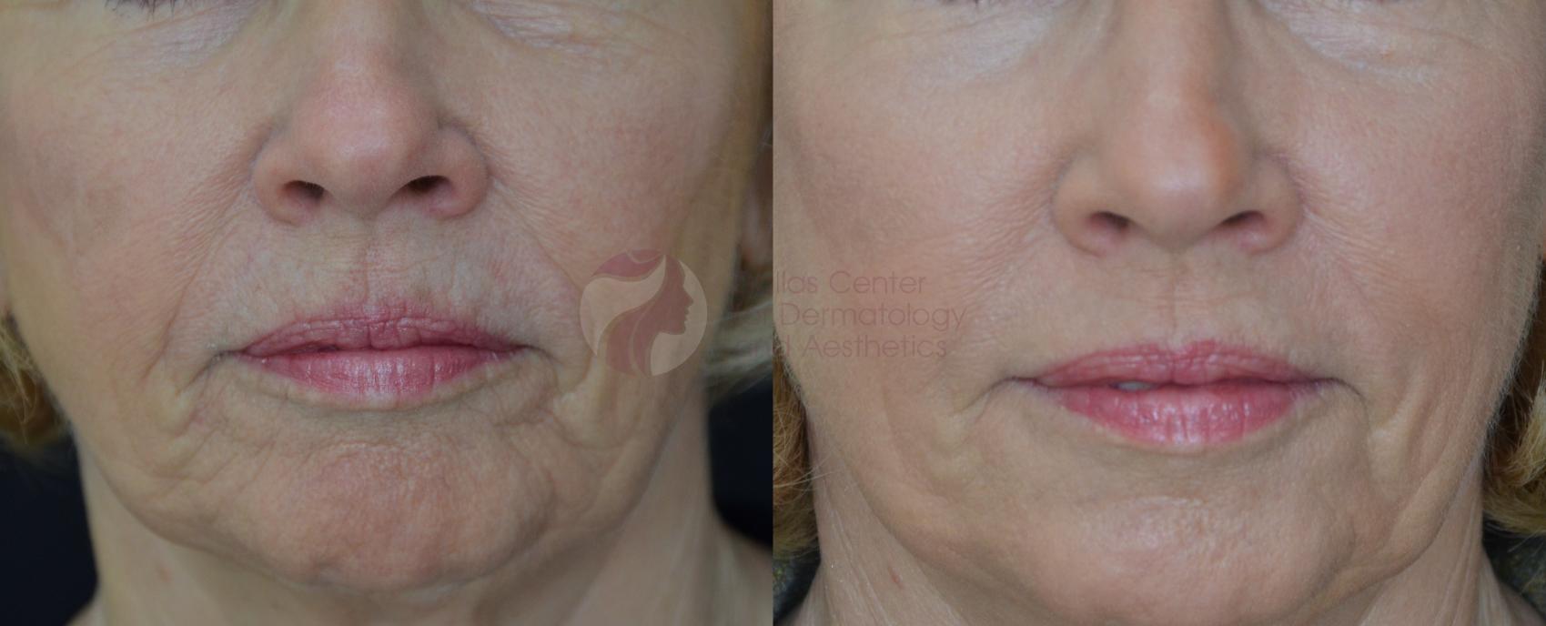 Before & After Skin Resurfacing Case 57 View #2 View in Dallas, Plano, and Frisco, TX