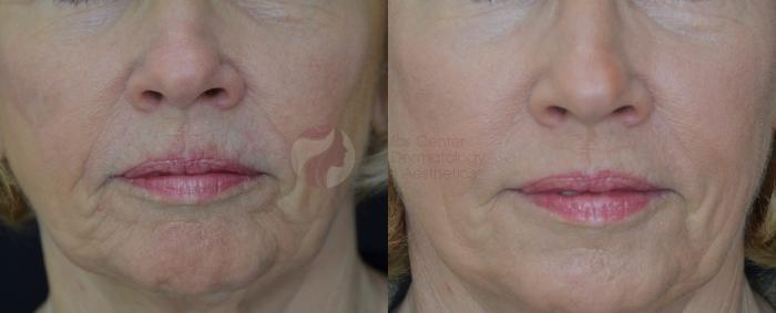 Before & After Skin Resurfacing Case 57 View #2 View in Dallas, TX