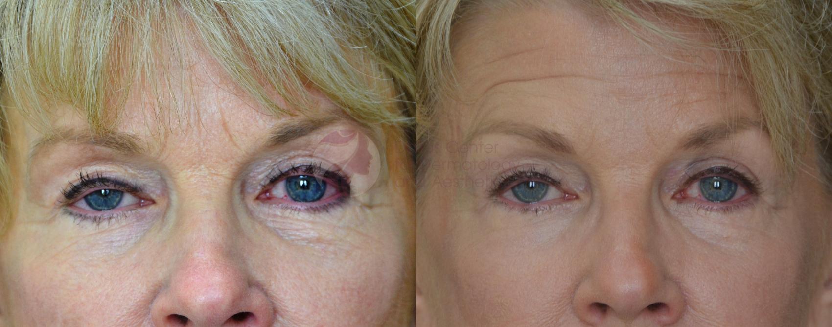 Before & After Skin Resurfacing Case 57 View #3 View in Dallas, Plano, and Frisco, TX