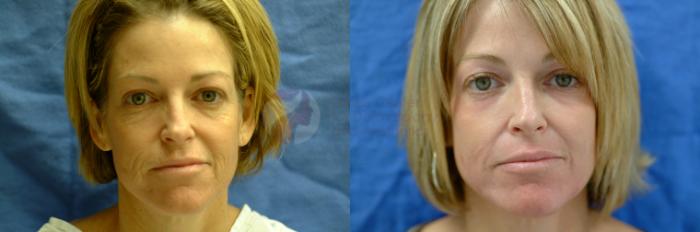 Before & After Skin Resurfacing Case 6 View #1 View in Dallas, TX