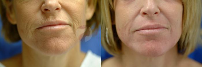 Before & After Skin Resurfacing Case 6 View #2 View in Dallas, TX