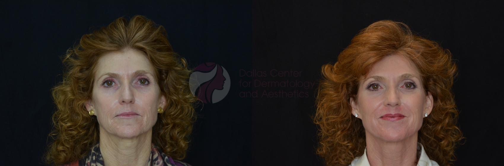 Before & After Skin Resurfacing Case 71 View #1 View in Dallas, Plano, and Frisco, TX