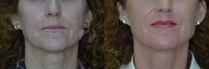 Before & After Skin Resurfacing Case 71 View #2 View in Dallas, TX