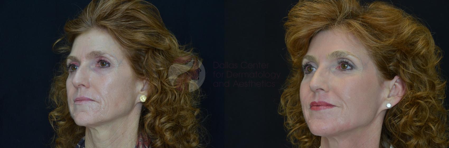 Before & After Skin Resurfacing Case 71 View #3 View in Dallas, TX